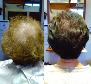 富山の女性の髪質改善ボリュームアップ